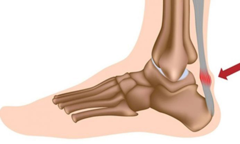 Trẻ đi nhón chân và chậm nói là bị gì