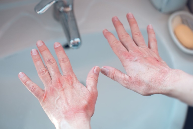 Rửa tay quá nhiều lần do rối loạn ám ảnh cưỡng chế gây tổn thương da tay